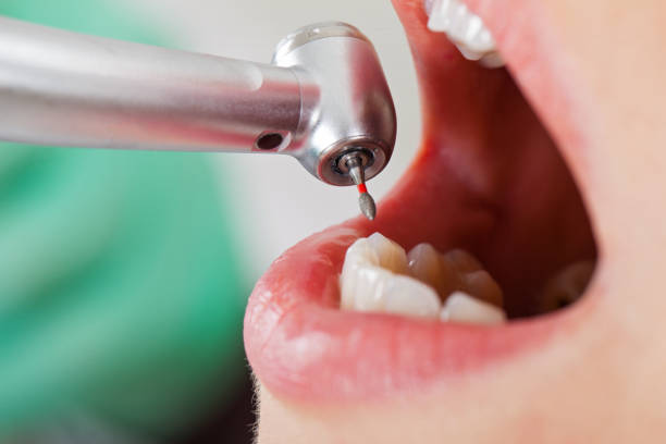 Best Emergency Wisdom Teeth Removal in Mount Pulaski, IL